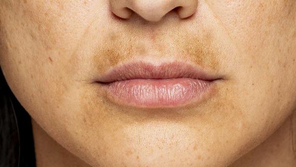 Cô gái che nắng cẩn thận khi ra ngoài, đại diện cho việc bảo vệ da sau khi trị nám bằng lá tía tô